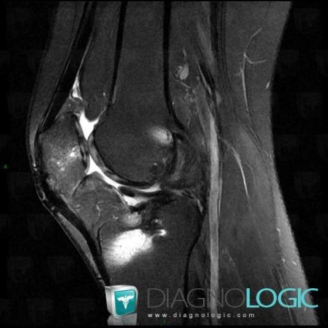 Anterior cruciate ligament rupture, Anterior cruciate ligament, MRI