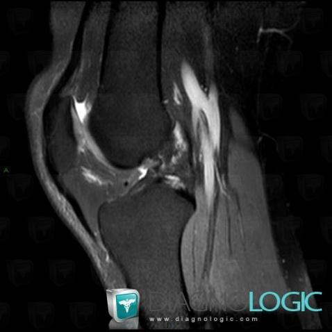 Anterior cruciate ligament rupture, Anterior cruciate ligament, MRI