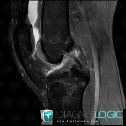 Anterior cruciate ligament rupture, Anterior cruciate ligament, MRI