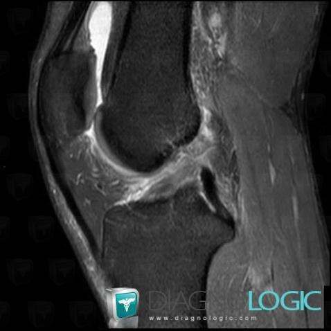 Anterior cruciate ligament rupture, Anterior cruciate ligament, MRI