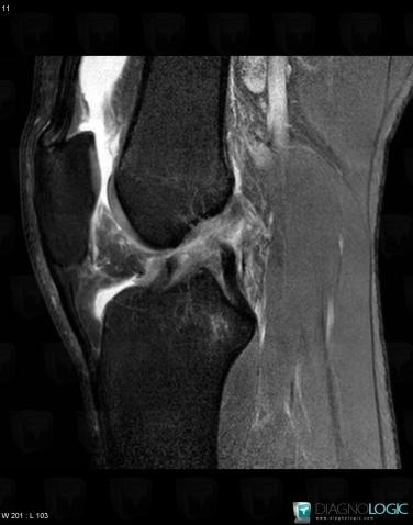 Anterior cruciate ligament rupture, Anterior cruciate ligament, MRI