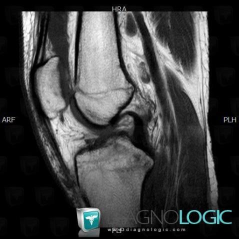 Anterior cruciate ligament rupture, Anterior cruciate ligament, MRI