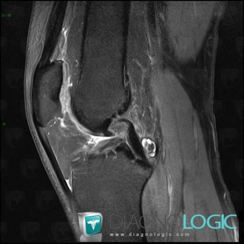 Anterior cruciate ligament rupture, Anterior cruciate ligament, MRI