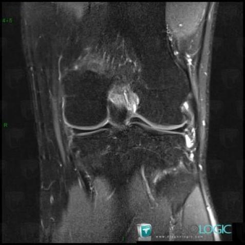 Anterior cruciate ligament rupture, Anterior cruciate ligament, MRI