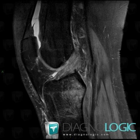 Anterior cruciate ligament rupture, Anterior cruciate ligament, MRI