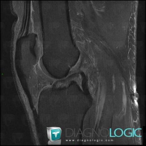 Anterior cruciate ligament rupture, Anterior cruciate ligament, MRI