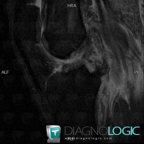 Anterior cruciate ligament rupture, Anterior cruciate ligament, MRI