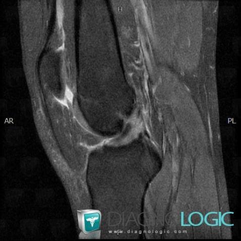 Anterior cruciate ligament rupture, Anterior cruciate ligament, MRI