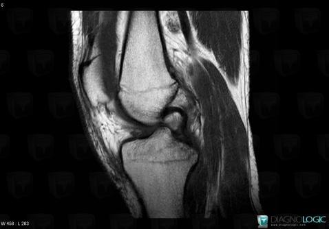 Anterior cruciate ligament rupture, Anterior cruciate ligament, MRI