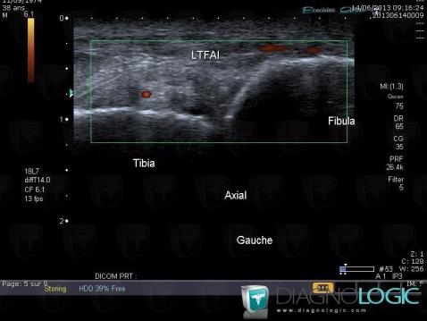 Anterior inferior tibiofibular ligament tear, Other ligaments - Ankle, US