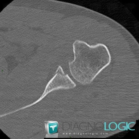 Anterior labral lesion / Shoulder, Gleno humeral joint, CT