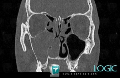 Radiology case : Antrochoanal polyp (CT) - Diagnologic