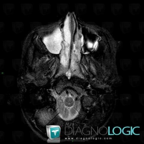 Antrochoanal polyp, Sinus, MRI