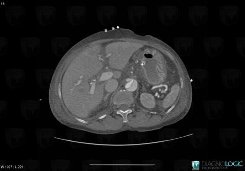 Aortic dissection, Abdominal aorta, CT