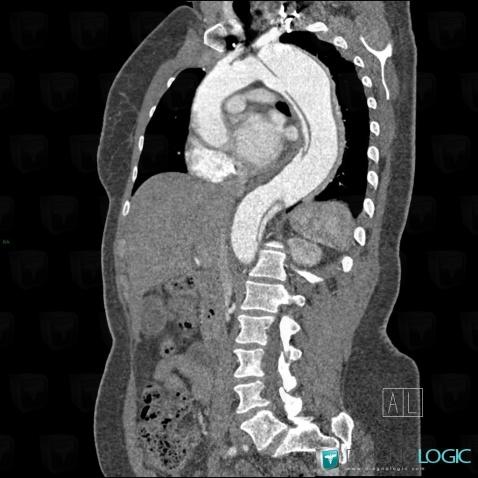 Aortic dissection, Aorta, CT