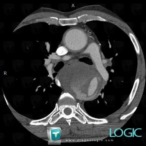 Aortic dissection, Aorta, CT