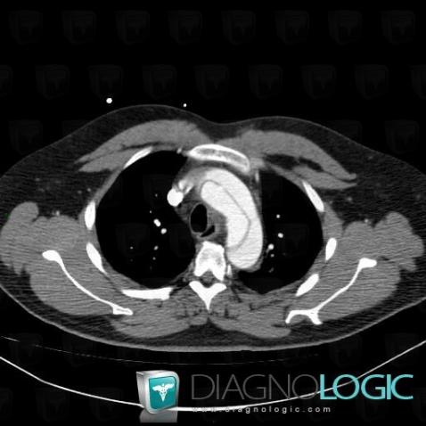 Aortic dissection, Aorta, CT