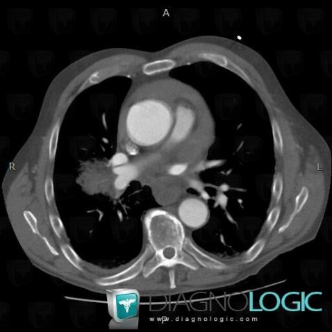 Aortic dissection, Aorta, CT