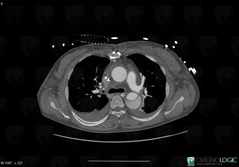 Aortic dissection, Aorta, CT