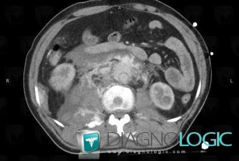 Aortic rupture , Abdominal aorta, CT