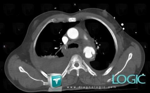 Aortic rupture , Aorta, CT