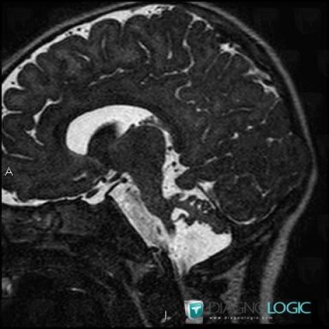 Aplasia-cerebellum, Cerebellar hemisphere, Posterior fossa, MRI