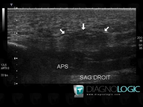 Aponévrosite plantaire, Aponévrose plantaire, Echographie