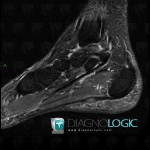 Aponévrosite plantaire, Aponévrose plantaire, IRM