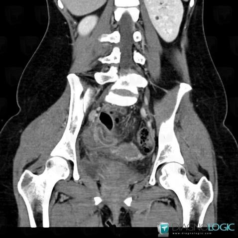 Appendicitis, Caecum / Appendix, CT