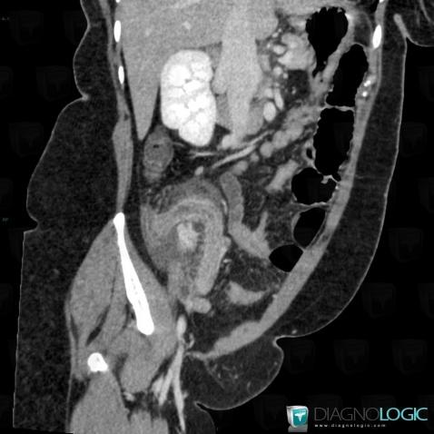 Appendicitis, Caecum / Appendix, CT