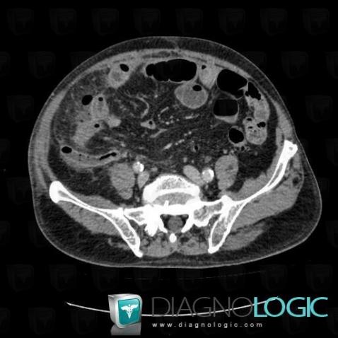 Appendicitis, Caecum / Appendix, CT