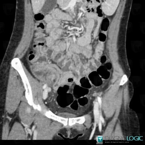 Radiology case : Appendicitis (CT) - Diagnologic