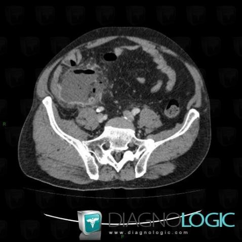 Appendicitis, Caecum / Appendix, CT