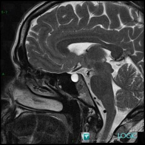 Arachnoid cyst, Cerebral falx / Midline, MRI