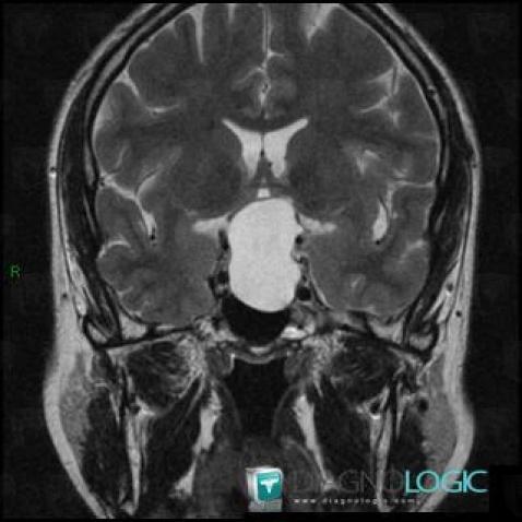 Arachnoid cyst, Cerebral hemispheres, Cerebral falx / Midline, MRI