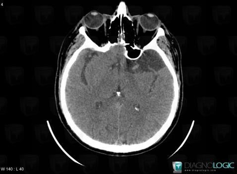 Arachnoid cyst, Cerebral hemispheres, CT