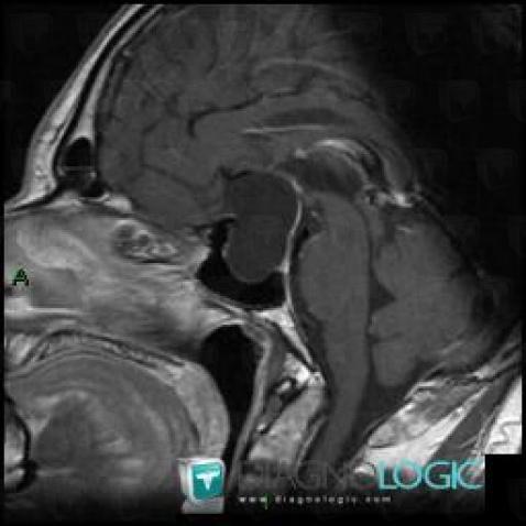Arachnoid cyst, Cerebral hemispheres, MRI
