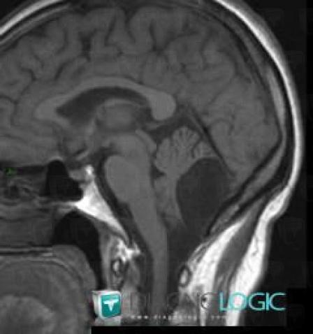 Arachnoid cyst, Infratentorial peri cerebral spaces, Posterior fossa, MRI