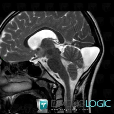 Arachnoid cyst, Infratentorial peri cerebral spaces, Posterior fossa, MRI