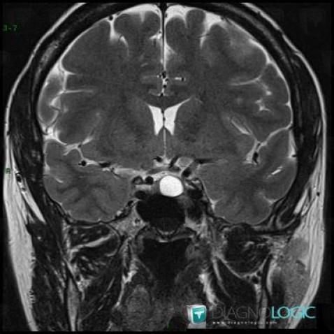 Arachnoid cyst, Pituitary gland and parasellar region, MRI