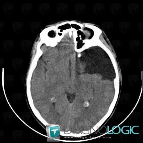 Arachnoid cyst, Posterior fossa, CT