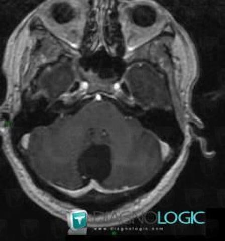 Arachnoid cyst, Posterior fossa, MRI