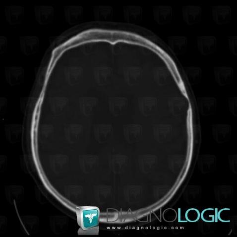 Arachnoid cyst, Skull vault, CT