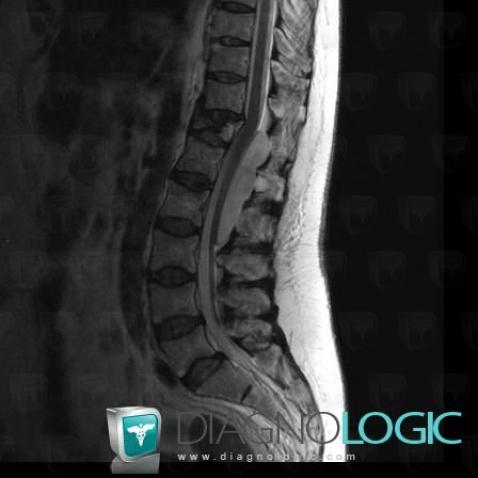 Arachnoid cyst, Spinal canal / Cord, MRI