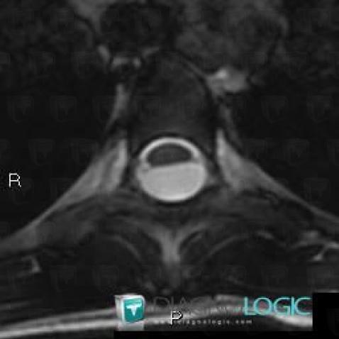 Arachnoid cyst, Spinal canal / Cord, MRI