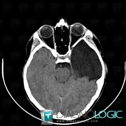 Arachnoid cyst, Supratentorial peri cerebral spaces, Cerebral hemispheres, CT