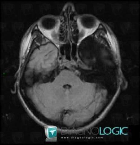 Arachnoid cyst, Supratentorial peri cerebral spaces, Cerebral hemispheres, MRI