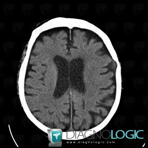 Arachnoid cyst, Supratentorial peri cerebral spaces, CT