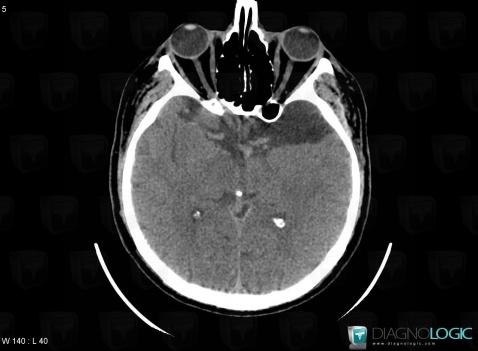 Arachnoid cyst, Supratentorial peri cerebral spaces, CT