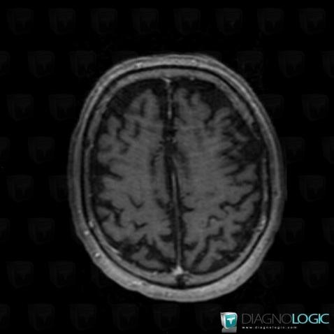 Arachnoid cyst, Supratentorial peri cerebral spaces, MRI